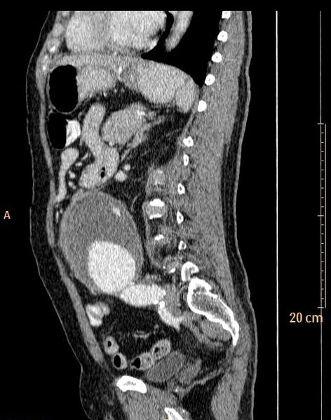 File:Abdominal aortic aneurysm (Radiopaedia 25985-26121 Sagittal C+ arterial phase 6).jpg