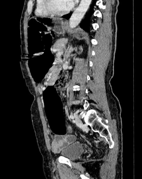 File:Abdominal aortic aneurysm (Radiopaedia 83581-98689 Sagittal C+ portal venous phase 73).jpg