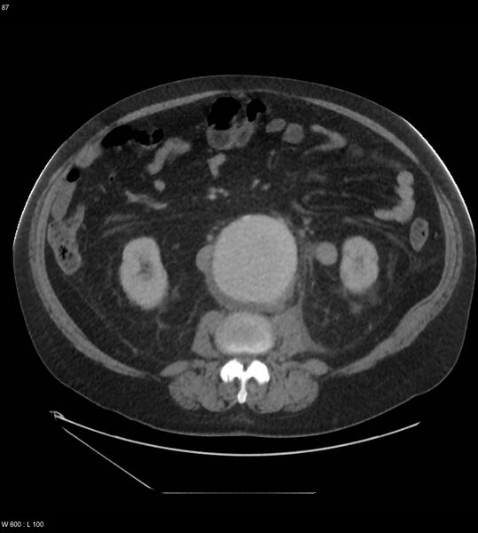 File:Abdominal aortic aneurysm with intramural hematoma then rupture (Radiopaedia 50278-55631 Axial C+ arterial phase 78).jpg