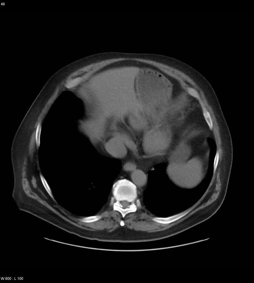 Abdominal aortic aneurysm with intramural hematoma then rupture (Radiopaedia 50278-55631 Axial non-contrast 42).jpg