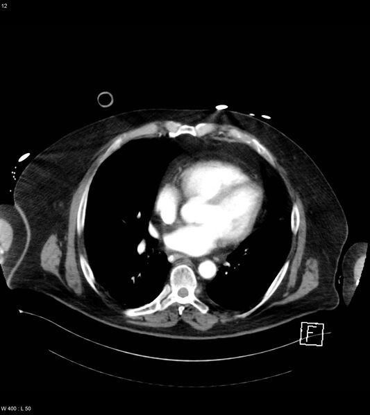 File:Abdominal aortic aneurysm with intramural hematoma then rupture (Radiopaedia 50278-55632 Axial C+ arterial phase 11).jpg