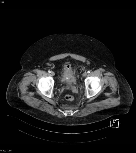 File:Abdominal aortic aneurysm with intramural hematoma then rupture (Radiopaedia 50278-55632 Axial C+ arterial phase 154).jpg