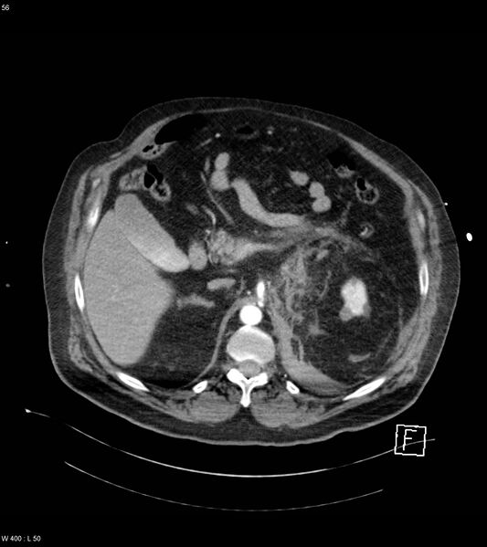 File:Abdominal aortic aneurysm with intramural hematoma then rupture (Radiopaedia 50278-55632 Axial C+ arterial phase 55).jpg