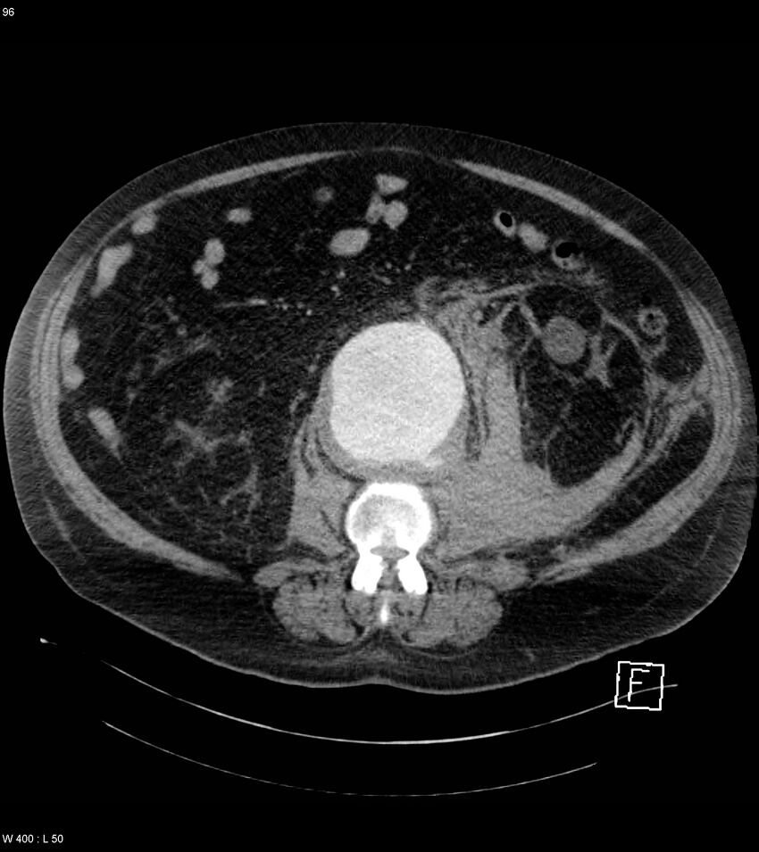 Abdominal aortic aneurysm with intramural hematoma then rupture (Radiopaedia 50278-55632 Axial C+ arterial phase 95).jpg