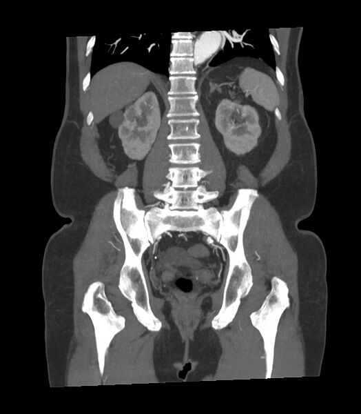 File:Abdominal aortic aneurysm with thrombus fissuration (Radiopaedia 46218-50618 Coronal C+ arterial phase 10).jpg