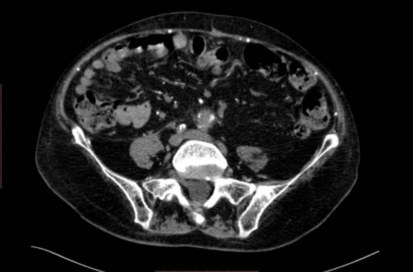Abdominal aortic interposition tube graft and aneurysm thrombosis (Radiopaedia 71438-81857 Axial C+ arterial phase 135).jpg