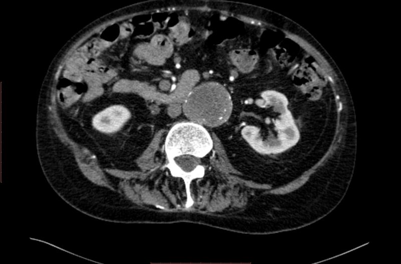 File:Abdominal aortic interposition tube graft and aneurysm thrombosis (Radiopaedia 71438-81857 Axial C+ arterial phase 74).jpg