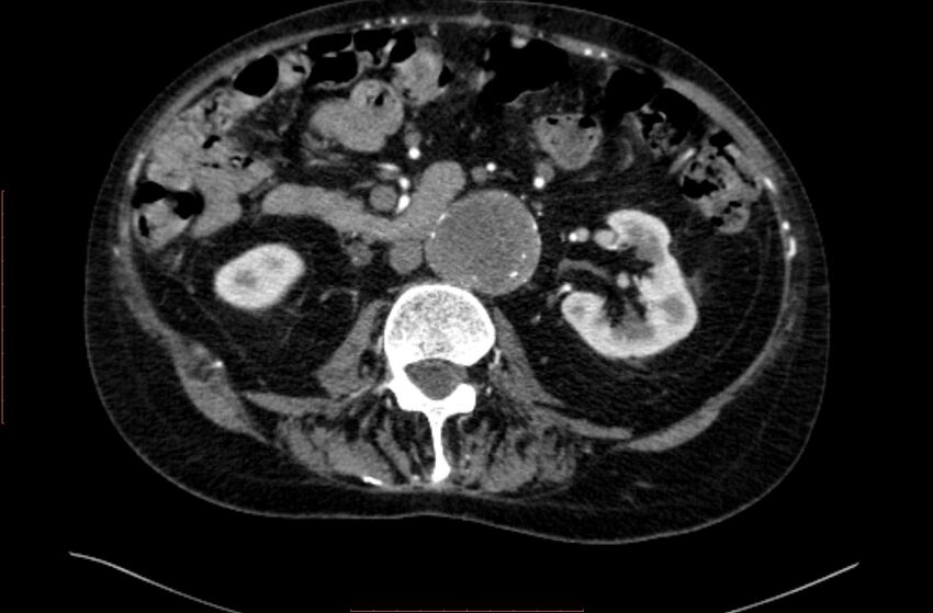 Abdominal aortic interposition tube graft and aneurysm thrombosis (Radiopaedia 71438-81857 Axial C+ arterial phase 74).jpg