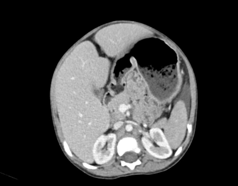File:Abdominal premesenteric cystic lymphangioma (Radiopaedia 82995-97350 Axial C+ portal venous phase 20).jpg