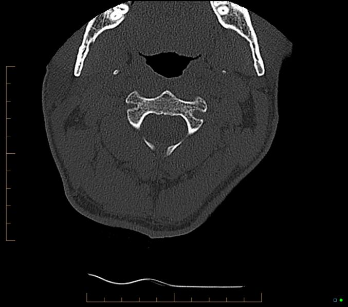 File:Accessory articulation of cervical transverse processes (Radiopaedia 82715-96933 Axial non-contrast 33).jpg