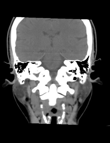 File:Accessory parotid glands (Radiopaedia 27289-27472 Coronal non-contrast 4).jpg