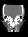 Accessory parotid glands (Radiopaedia 27289-27472 Coronal non-contrast 4).jpg