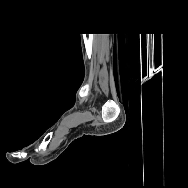 File:Accessory soleus muscle (Radiopaedia 61069-68943 C 35).jpg
