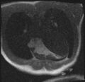 Active right ventricular cardiac sarcoidosis (Radiopaedia 55596-62100 Axial Dynamic perfusion scan MOCO 30).jpg
