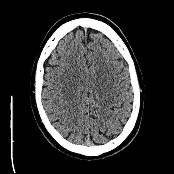 File:Acute A3 occlusion with ACA ischemic penumbra (CT perfusion) (Radiopaedia 72036-82525 Axial non-contrast thins 79).jpg