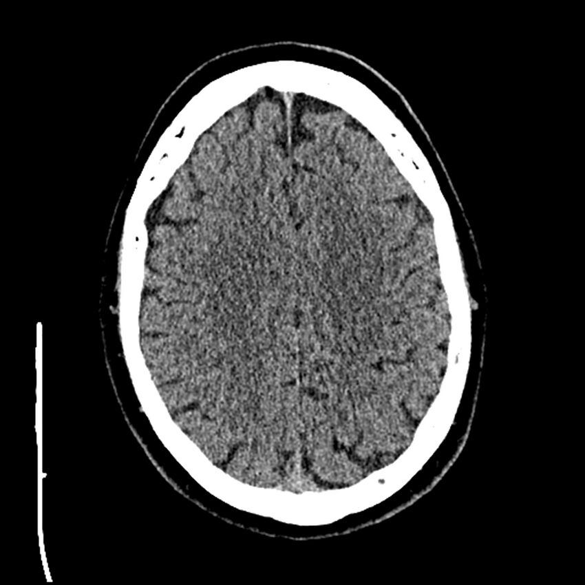 Acute A3 occlusion with ACA ischemic penumbra (CT perfusion) (Radiopaedia 72036-82525 Axial non-contrast thins 79).jpg