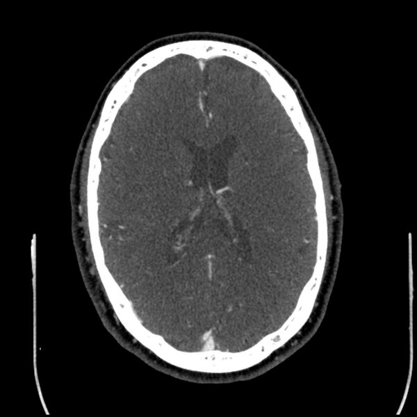 File:Acute A3 occlusion with ACA ischemic penumbra (CT perfusion) (Radiopaedia 72036-82527 Axial C+ arterial phase thins 44).jpg