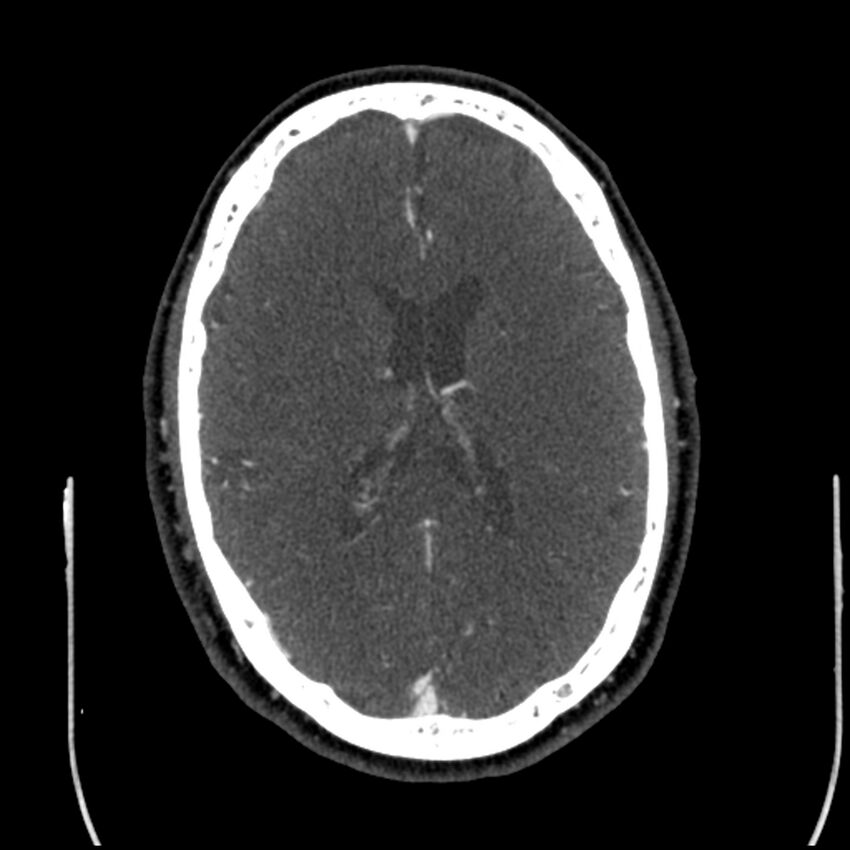 Acute A3 occlusion with ACA ischemic penumbra (CT perfusion) (Radiopaedia 72036-82527 Axial C+ arterial phase thins 44).jpg