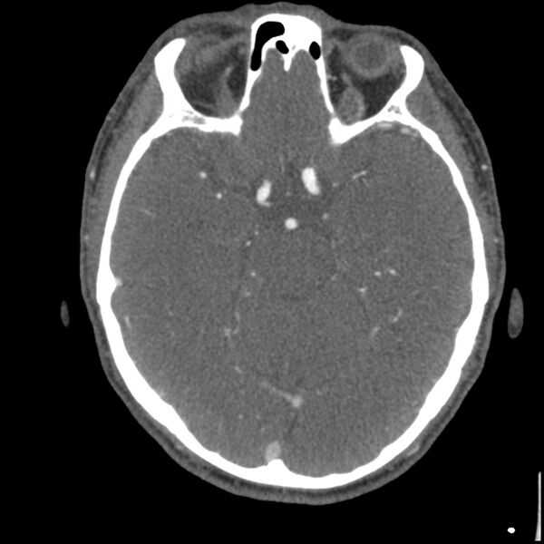 File:Acute P1 occlusion with PCA ischemia penumbra (CT perfusion) (Radiopaedia 72084-82587 Axial C+ arterial thins 50).jpg