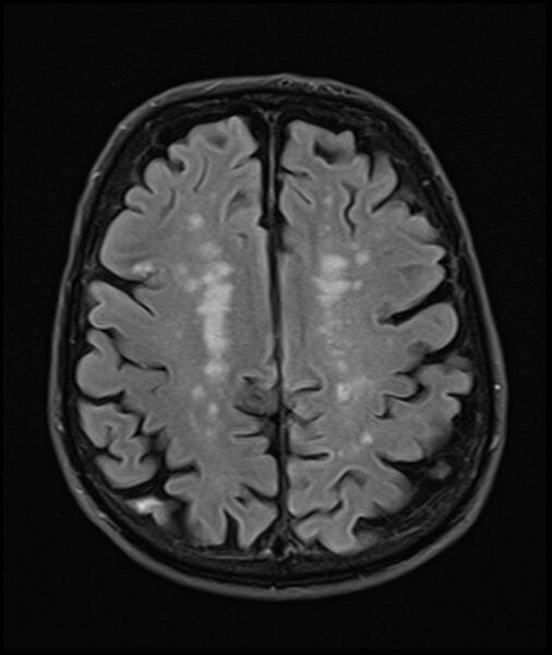 File:Acute P1 occlusion with PCA ischemia penumbra (CT perfusion) (Radiopaedia 72084-82590 Axial FLAIR 27).jpg