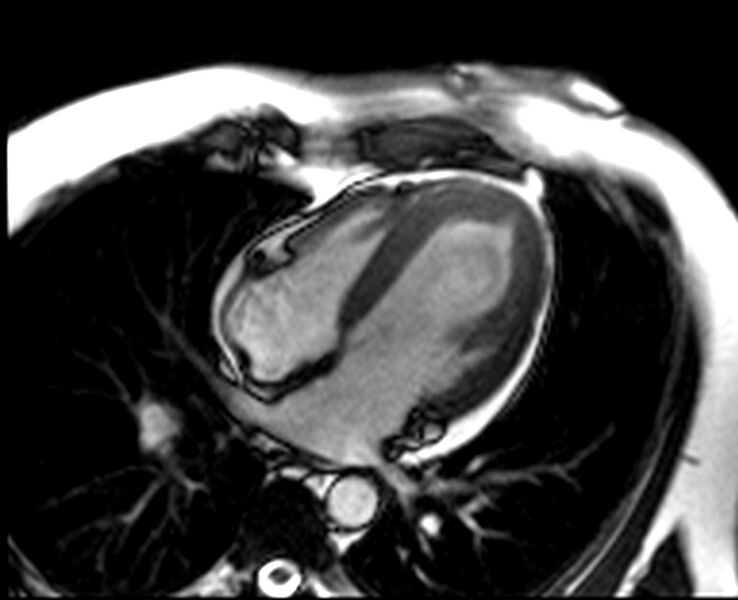 File:Acute anteroseptal myocardial infarction (Radiopaedia 68409-77944 Four chambers view SSFP cine 19).jpg