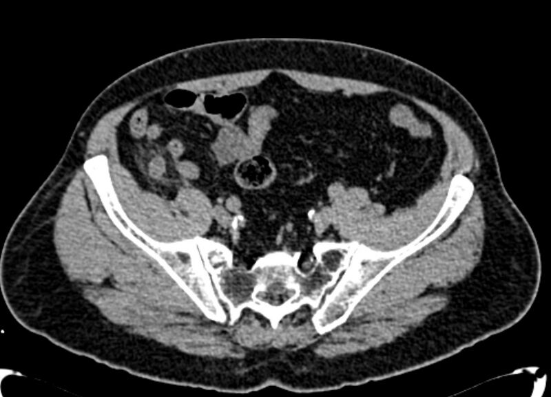 File:Acute appendicitis (Radiopaedia 13030-13091 Axial non-contrast 48).jpg