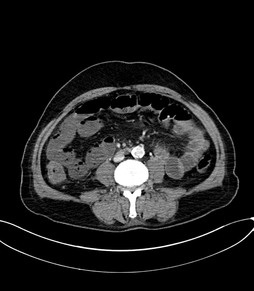Acute arterial mesenteric ischemia (Radiopaedia 78238-90828 Axial C+ portal venous phase 76).jpg