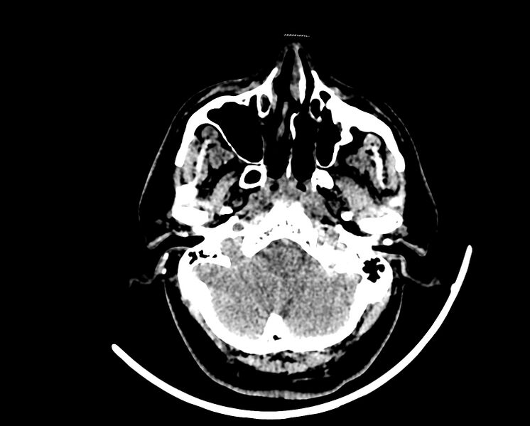 File:Acute cerebral infarct (Radiopaedia 35604-37123 Axial non-contrast 13).jpg