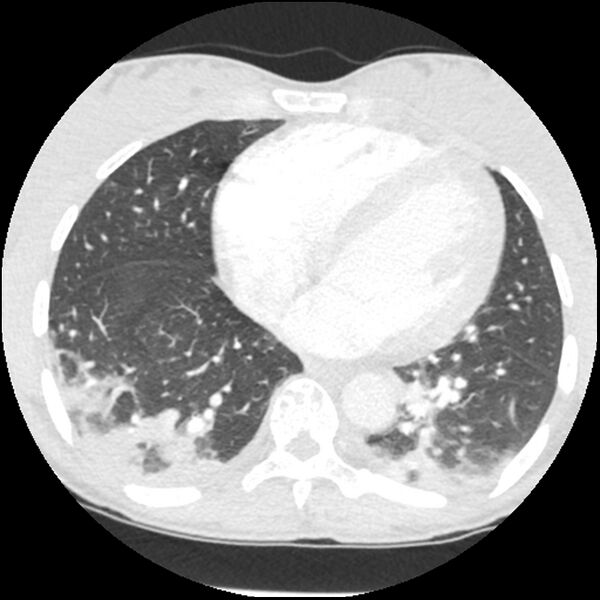 File:Acute chest syndrome - sickle cell disease (Radiopaedia 42375-45499 Axial lung window 131).jpg