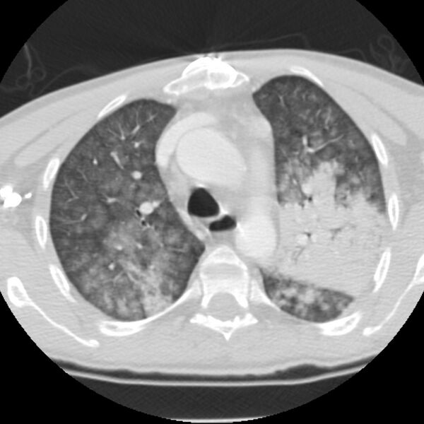 File:Acute diffuse alveolar hemorrhage (Radiopaedia 41323-44158 Axial lung window 17).jpg