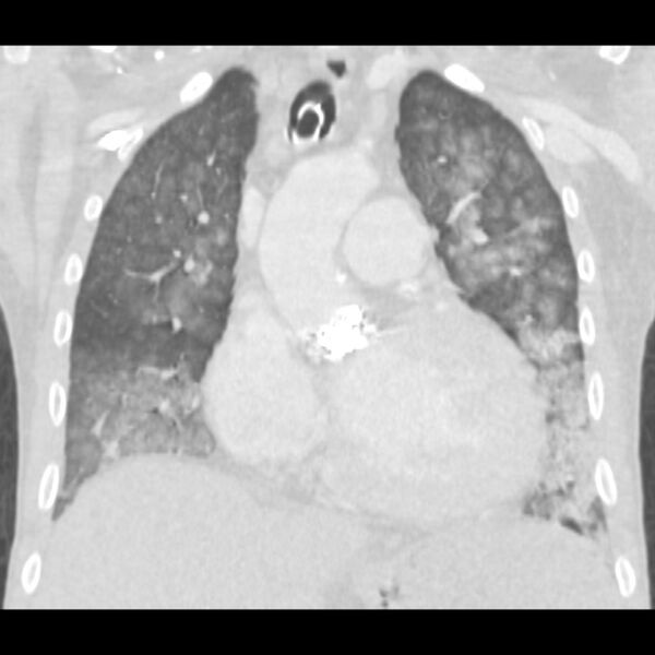 File:Acute diffuse alveolar hemorrhage (Radiopaedia 41323-44158 Coronal lung window 19).jpg