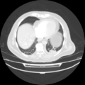 Acute heart failure (CT) (Radiopaedia 79835-93075 Axial lung window 36).png