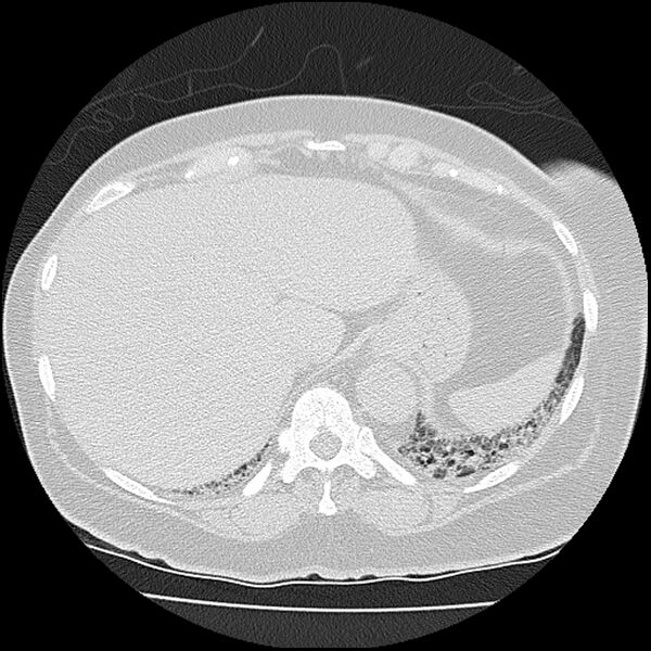 File:Acute interstitial pneumonitis (Radiopaedia 45404-49452 Axial lung window 81).jpg