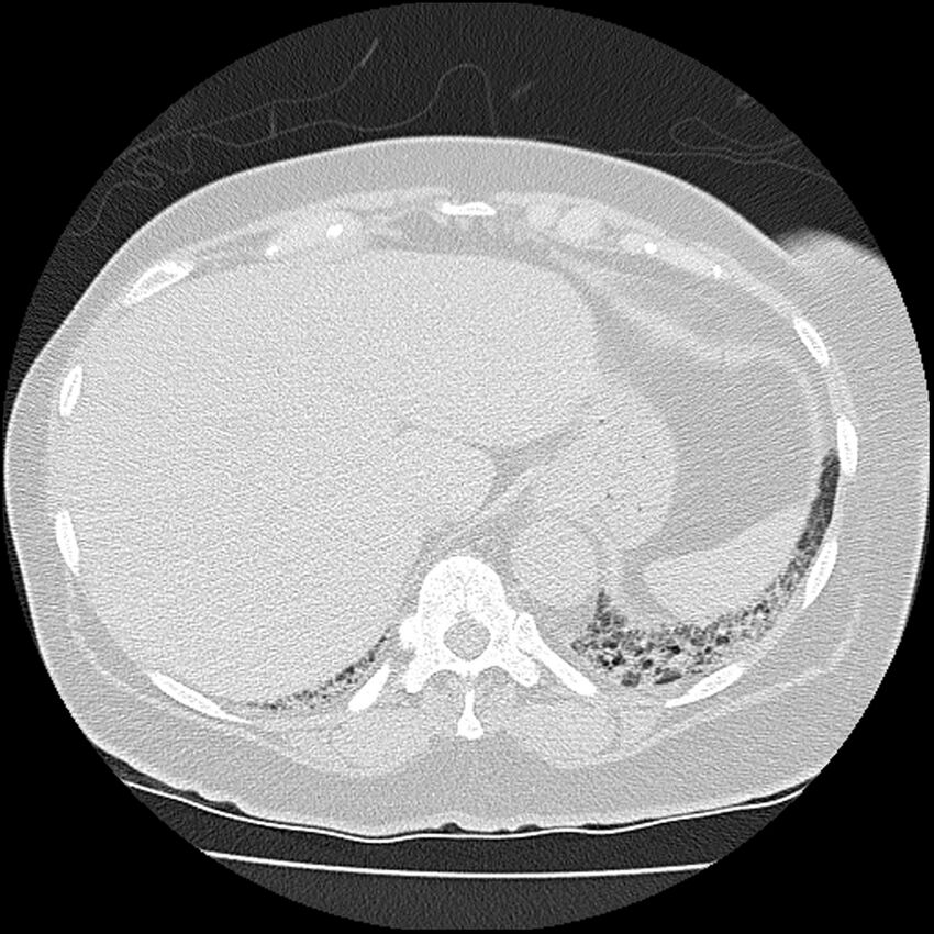 Acute interstitial pneumonitis (Radiopaedia 45404-49452 Axial lung window 81).jpg