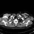 Acute myocardial infarction in CT (Radiopaedia 39947-42415 Axial C+ arterial phase 13).jpg