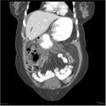 Acute pancreatitis (Radiopaedia 19136-19117 Coronal C+ portal venous phase 7).jpg