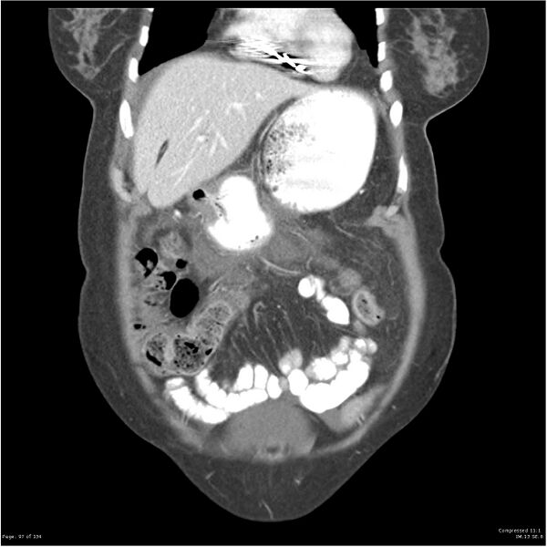 File:Acute pancreatitis (Radiopaedia 19136-19117 Coronal C+ portal venous phase 7).jpg