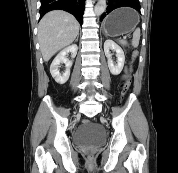 File:Acute pancreatitis (Radiopaedia 22572-22596 Coronal C+ portal venous phase 36).jpg