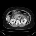 Acute pancreatitis - Balthazar C (Radiopaedia 26569-26714 Axial C+ portal venous phase 40).jpg