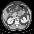 Acute pancreatitis - mild (Radiopaedia 27796-28033 C+ portal venous phase 14).jpg