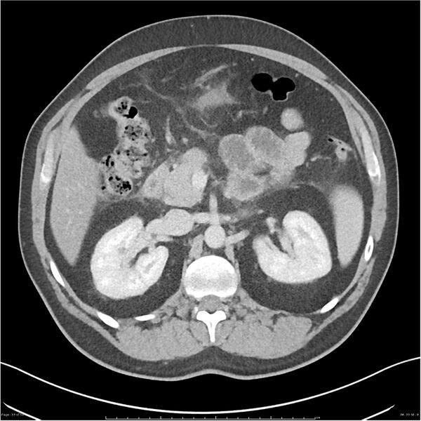 File:Acute pancreatitis - mild (Radiopaedia 27796-28033 C+ portal venous phase 14).jpg