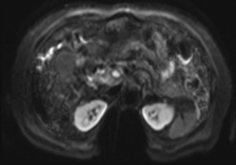 File:Acute portal vein thrombosis (Radiopaedia 73198-83925 Axial DWI 16).jpg