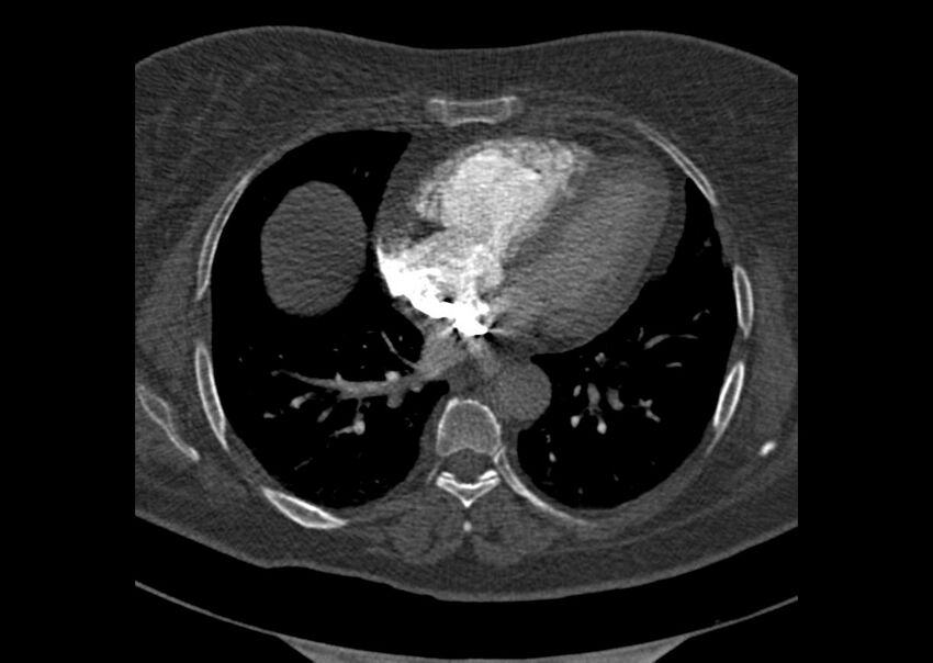 Acute pulmonary embolism (Radiopaedia 29938-30466 Axial C+ CTPA 139).jpg