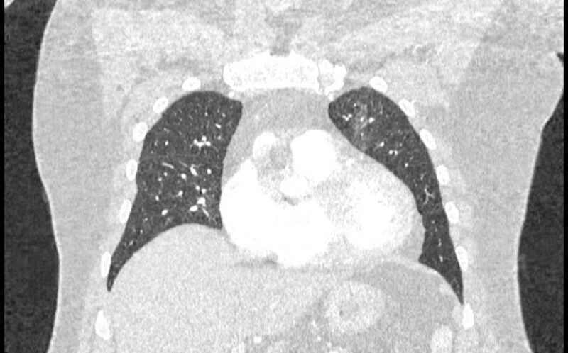 File:Acute pulmonary embolism with pulmonary infarcts (Radiopaedia 77688-89908 Coronal lung window 18).jpg