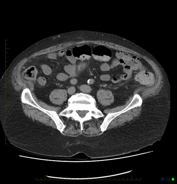 File:Acute renal failure post IV contrast injection- CT findings (Radiopaedia 47815-52557 Axial non-contrast 56).jpg