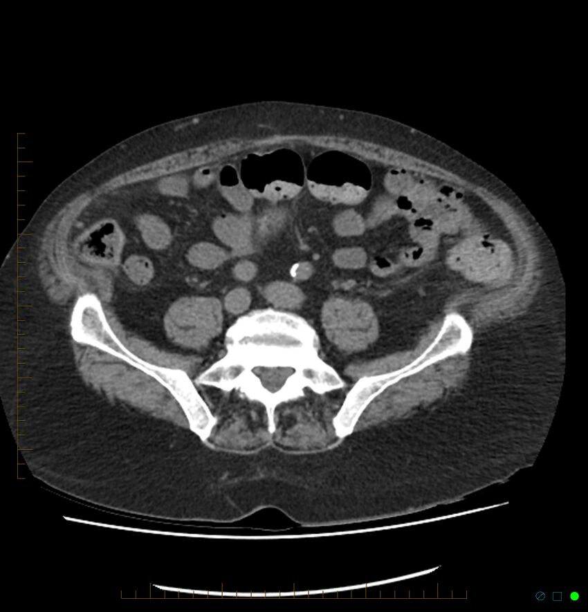 Acute renal failure post IV contrast injection- CT findings (Radiopaedia 47815-52557 Axial non-contrast 56).jpg