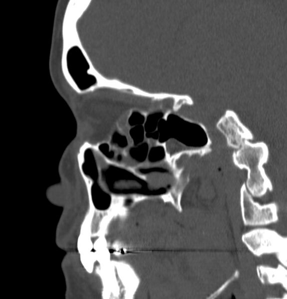 File:Acute sinusitis (Radiopaedia 22419-22455 Sagittal non-contrast 9).jpg