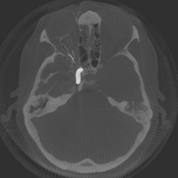 File:Acute subarachnoid hemorrhage and accessory anterior cerebral artery (Radiopaedia 69231-79010 Axial arterial - MIP 22).jpg