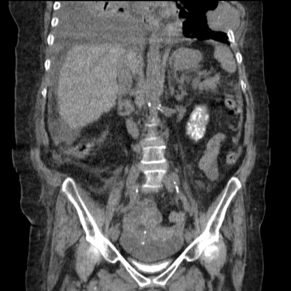 File:Acute tubular necrosis (Radiopaedia 28077-28334 G 48).jpg