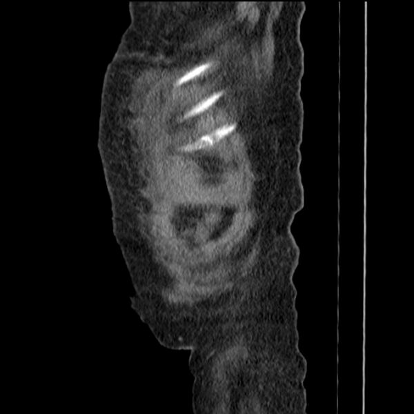 File:Acute tubular necrosis (Radiopaedia 28077-28334 Sagittal non-contrast 8).jpg